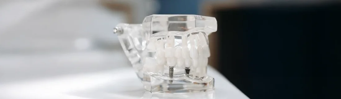 3D Guided Implant Surgery in Mill Creek WA