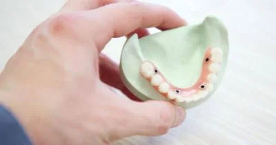 A photo of a mouth model indicating where implants would be placed