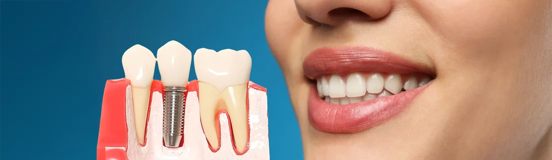 Immediate Implants in Mill Creek WA