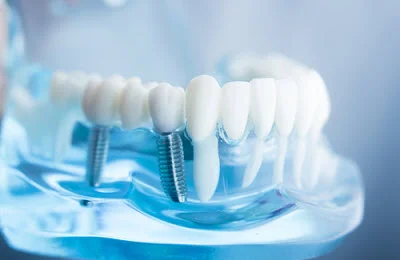 A mouth model with transparent gums to show what implants look like when installed