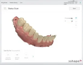 A computerized 3D model of a patient's mouth with use of the Intraoral scanner