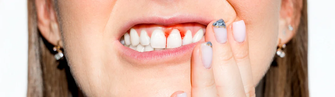 Peri-implantitis (Implant Infection) in Mill Creek WA