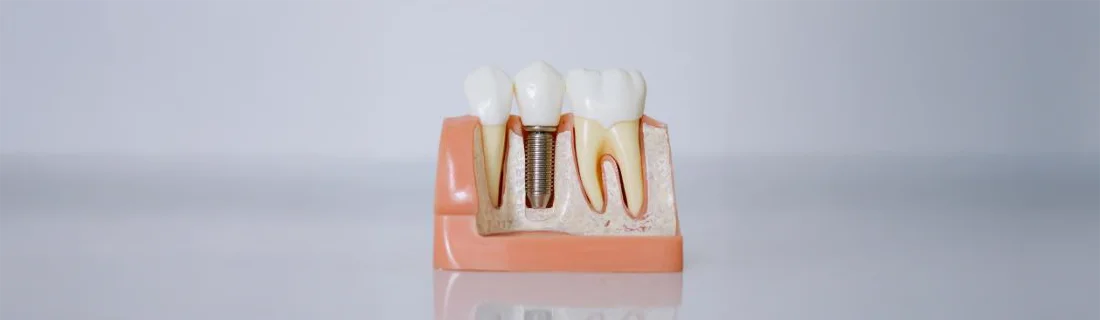 Surgical Dental Implants in Mill Creek WA